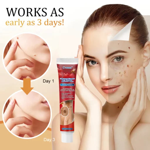 Cvreoz Bee Venom Wart and Tags Removal Treatment Cream