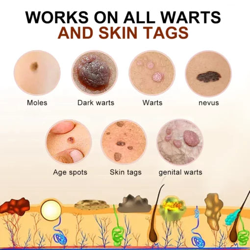 Cvreoz Bee Venom Wart and Tags Removal Treatment Cream