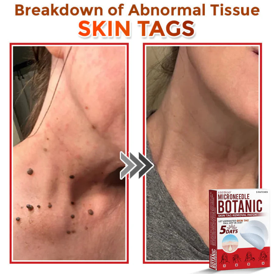 Fivfivgo® MicroNeedle Botanic Skin Tag Removal Patch