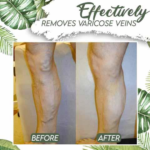 Hot Sale–Venous Disorder Home Treatment Set