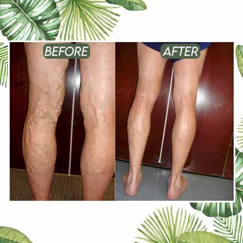 Hot Sale–Venous Disorder Home Treatment Set