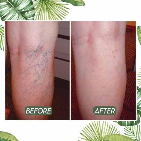 Hot Sale–Venous Disorder Home Treatment Set