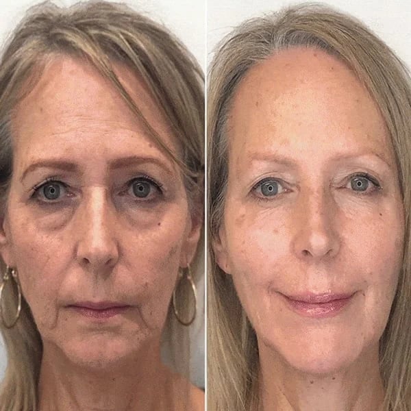 Tiworld™ Rapid Anti Wrinkle Serum, Face Lift Cream, Instant Wrinkle Remover for Face, Eye Bag and Neck, Wrinkle Cream for Face Deep Wrinkles
